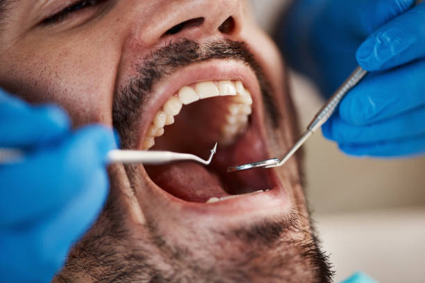 Best Emergency Dentist for Lost Fillings or Crowns in Monroe North, WA